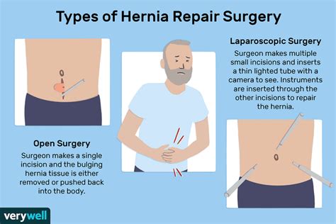 how long after hernia surgery can you swim? the importance of post-operative care in physical activities